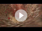 MEDICAL - How cholesterol clogs your arteries (atherosclerosis)